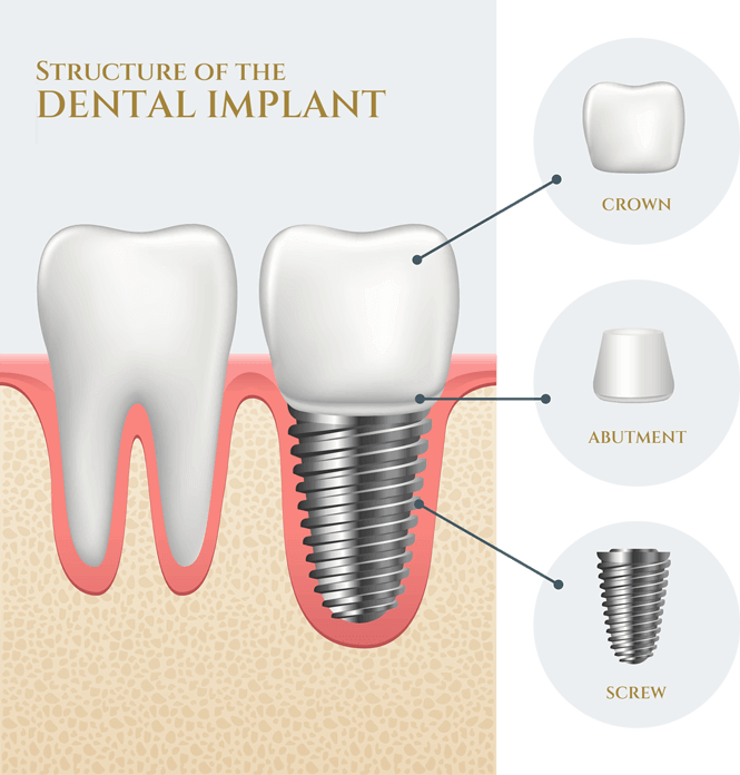 Have you lost all of your teeth?