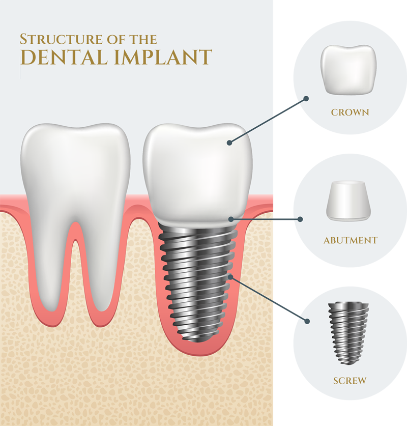 Dental implants Kent