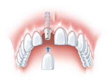 Single Tooth