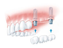 Multiple Teeth